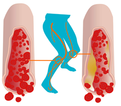 Peripheral Diabetic Neuropathy