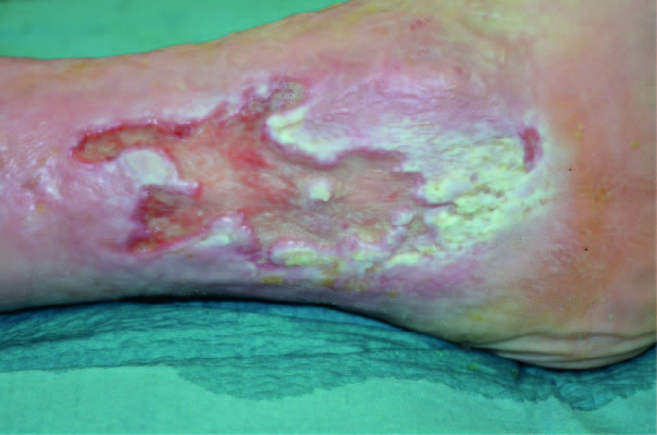 Treatment of a macerated Venous Leg Ulcer