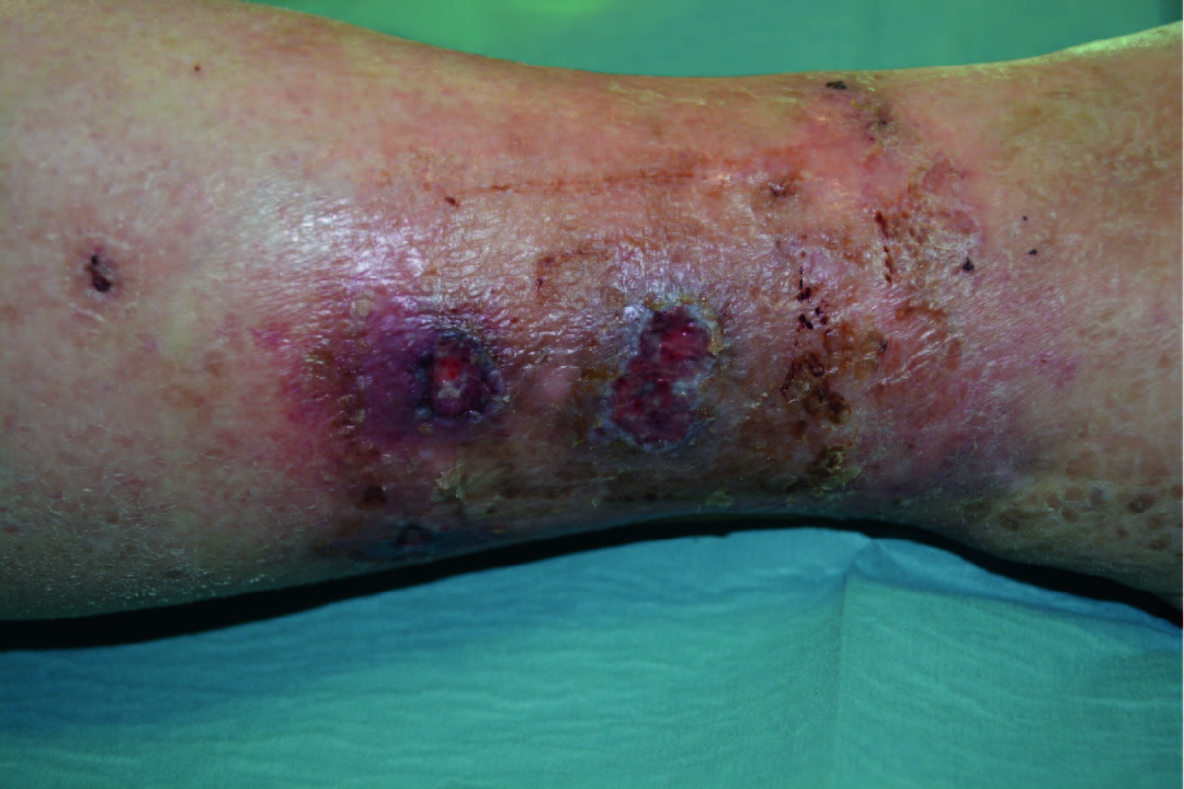 Treatment of an Arterial Leg Ulcer on lower leg