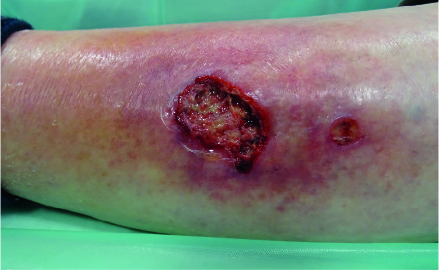 How to treat an infected diabetic foot ulcer  