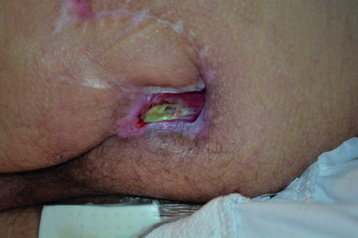 Patient wound cases