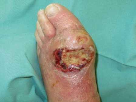 Diabetic Foot Ulcer