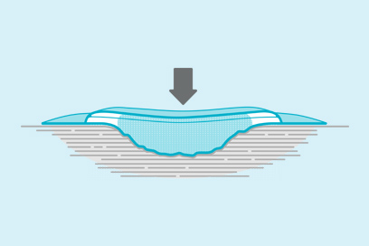 <h2>How to manage the gap & exudate</h2>