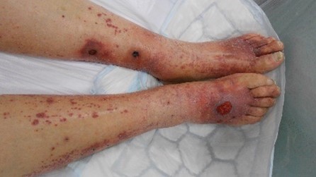 Leg Ulcers