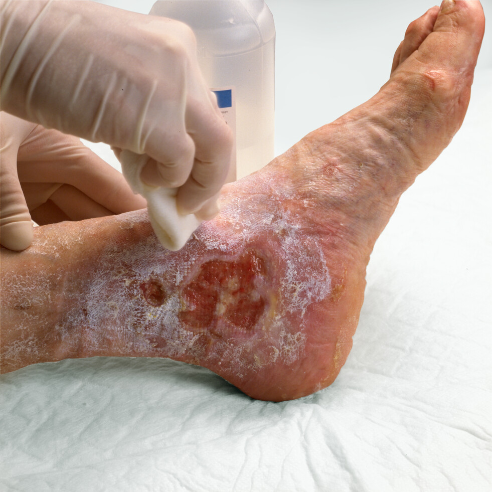 Clinical Wound Videos