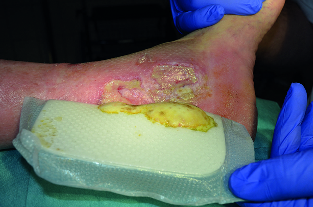 What is a silver dressing?