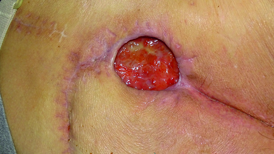 Sacral wound following dressing change