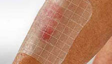 Wound monitoring