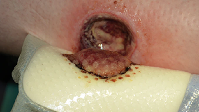 The role of ‘the gap’ in wound healing