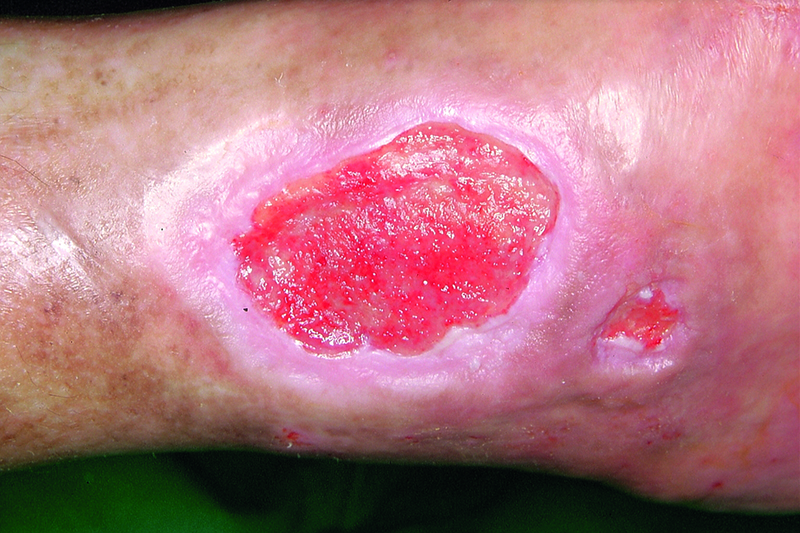 Wound healing