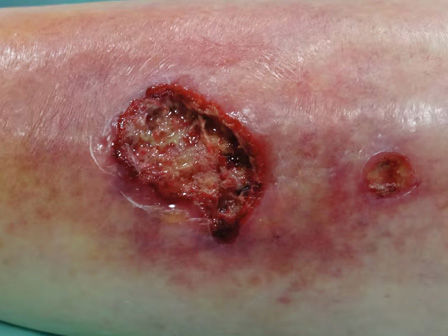 How to treat an infected diabetic foot ulcer
