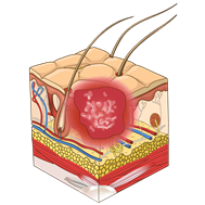 Stage 3 pressure ulcer
