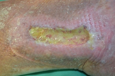 Wound Infection