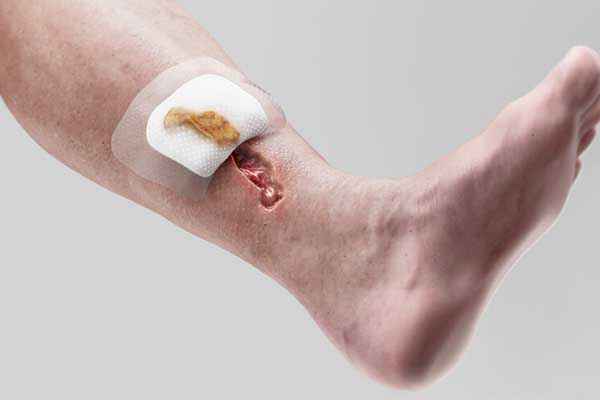 Wound types